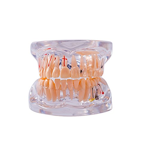 Modelo de patologia dental do Snawop com dentes de implante e doenças transparentes de dente padrão para